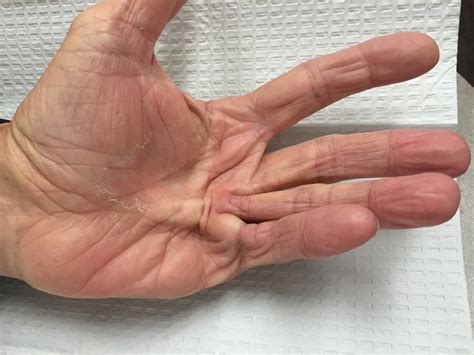 Lumps And Bumps And Cysts Of The Hand 2022