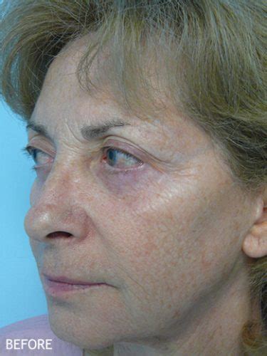 Skin Rejuvenation Patient 09 Temecula Ca Dr Kelly Oneil