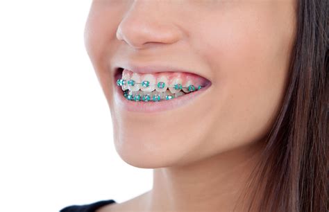 Once you feel you need braces installed, look for a reliable dental health professional, and book an appointment. How Do You Know if You Need Braces? - GVR Dental