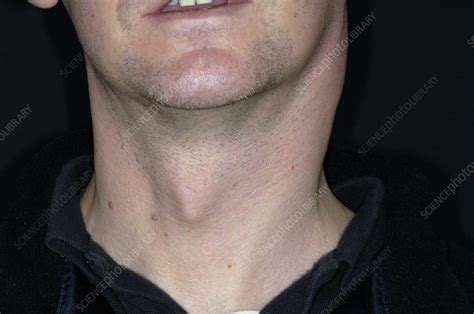 Swollen Lymph Nodes In Tonsillitis Stock Image C0051837 Science