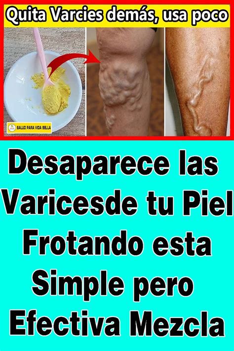 Pin En Remedios Caseros Para Las Varices Como Tratar Las Varices