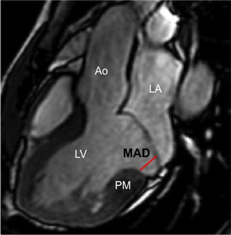 Bileaflet Mitral Valve Prolapse On Cine Cmr Images In A Patient With