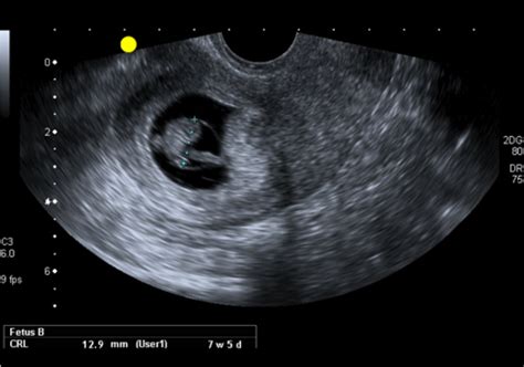 Basic Early Pregnancy Ultrasound Rcog Meded Academy