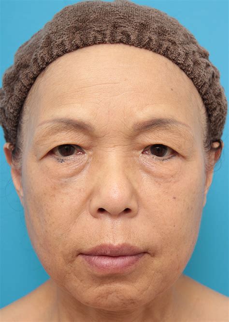 【症例写真】目の下、法令線、口周りシワにヒアルロン酸を6本注射した60代女性の症例：美容外科 高須クリニック