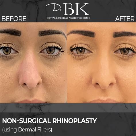 Before And After Gallery Drbk Cosmetic Dentist And Aesthetics Clinic