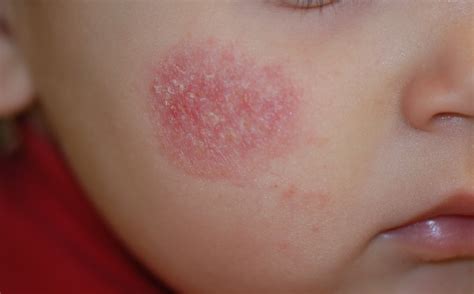 Dermatite Atopica Tutte Le Indicazioni Per Una Corretta Detersione