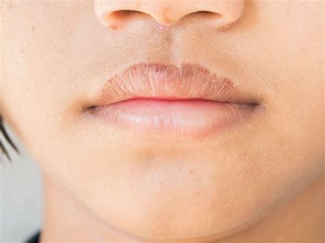 Lip Peeling Pictures Dry Lips Cheilitis Hypothyroidism Vitamins
