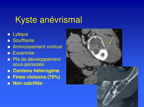 Ppt Aspect Radiologique Du Kyste Anevrismal Powerpoint Presentation