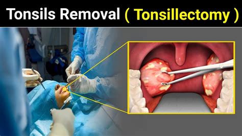 Tonsillectomy Procedure How Tonsils Remove Tonsils Tonsillitis
