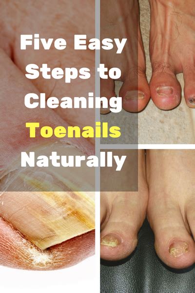 Five Easy Steps To Cleaning Toenails Naturally Posts By Sophia