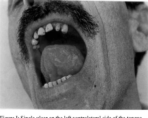 Figure I From Tongue Tuberculosis Secondary To Pulmonary Tuberculosis