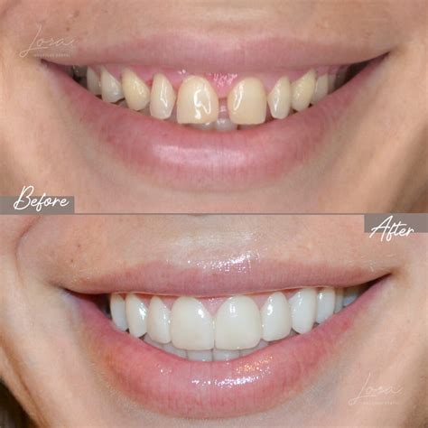 Diseño de sonrisa Antes y después Lora Boutique Dental Barcelona