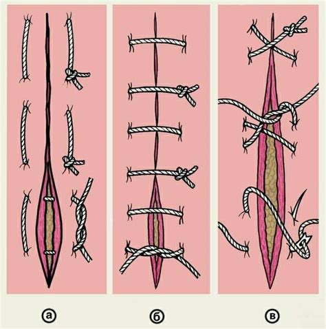 The 25 Best Surgical Suture Ideas On Pinterest Suture Types