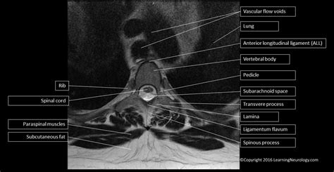 Thoracic Spine Mri Anatomy