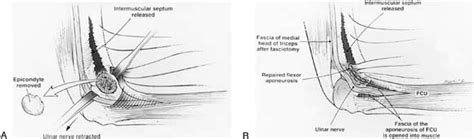 Cubital Tunnel Syndrome Anterior Transposition As A Logical Approach