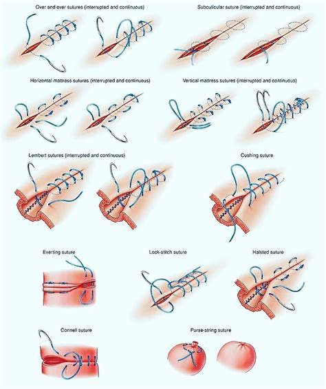Medical Mnemonics’s Instagram Photo “different Type Of Surgical Sutures” Surgical Suture