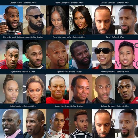 21 Black Celebrity Hair Transplants Before And After Photos