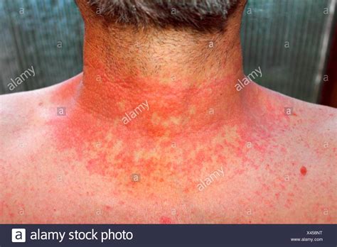 Skin Rash High Resolution Stock Photography And Images Alamy