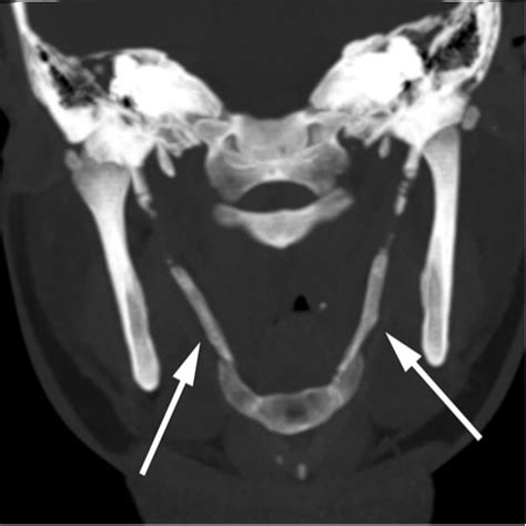 The Case Of Stylohyoid Calcification With Clarification Sleep TMJ
