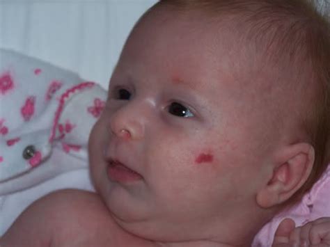 Everything You Need To Know About Your Babys Birthmarks And Their Types