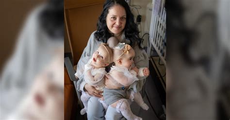 9 Month Old Conjoined Twins Separated After Marathon Surgery At Uc
