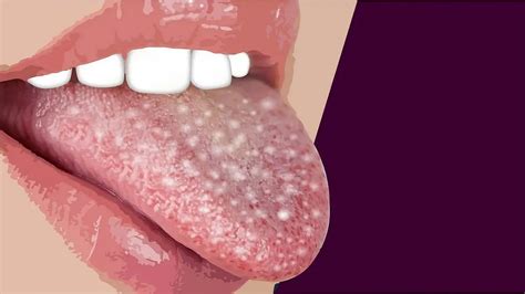 Tongue Disease Types Causes Symptoms Treatment Health Gov