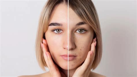 What Is The Difference Between Sun Spots And Melasma Ovo Medi Spa