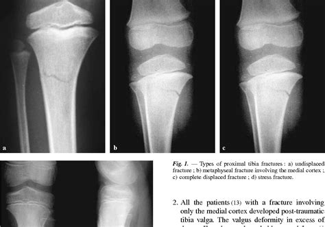 Figure 1 From The Effect Of Proximal Tibial Fractures On The Limb Axis