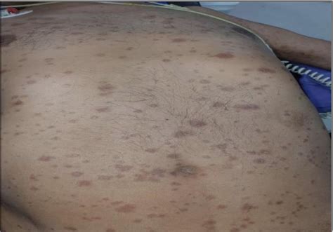 Figure 1 From Interstitial Granulomatous Dermatitis A Rare Case Report