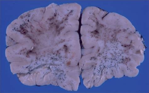 Sectioning Of The Brain Revealed Numerous Petechial Hemorrhages Within