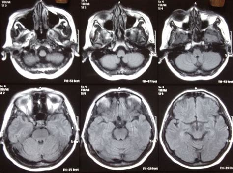 Mri Axial Plane Shows Diffuse Soft Tissue Enhancement And Stranding Of