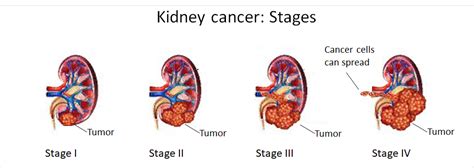 People with kidney cancer may experience the following symptoms or signs. Renal cell carcinoma - a rare disease in Germany ...