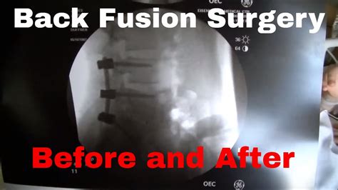 Back Fusion Surgery Before And After Surgery Day Youtube