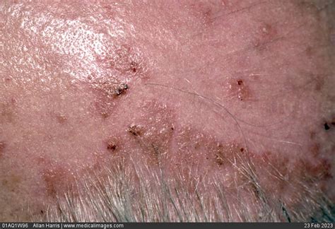 Stock Image Dermatology Moderate Psoriasis On Scalp Pink Patches With