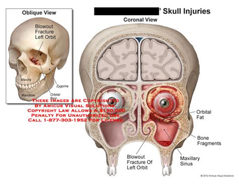 AMICUS Illustration Of Amicus Injury Skull Blowout Fracture Orbital