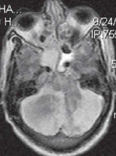 Diffusion Weighted Axial Mr Image Showing Bilateral Cerebellar Infarcts
