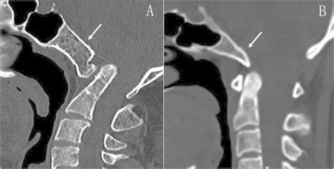 The Clivus White Arrows Shown On The Sagittal Ct Images In Patients