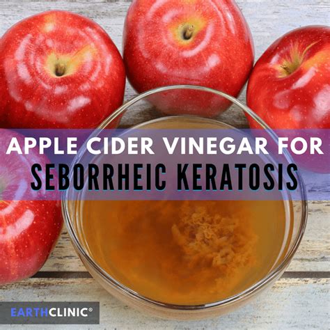 Discover The Power Of Apple Cider Vinegar For Seborrheic Keratosis