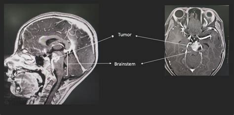 Surgical Technology Brain Stem Tumor In A Child Dr Savitr Sastri Bv