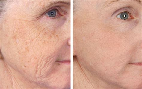 Effortless Anti Aging Cadence Cosmetics Wrinkle Reduction Treatments
