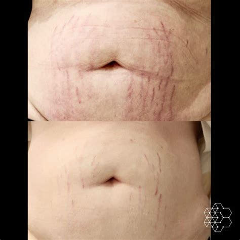 Lets Talk About Laser Stretch Mark Removal Treatment Skin Technique