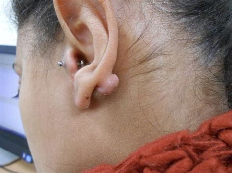 Keloids And Piercing The Relationship Between The Two