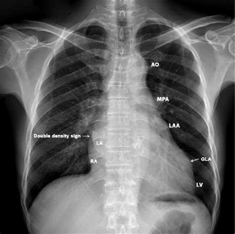 X Ray Chest Pa Postero Anterior View Showing The Bump Left Heart