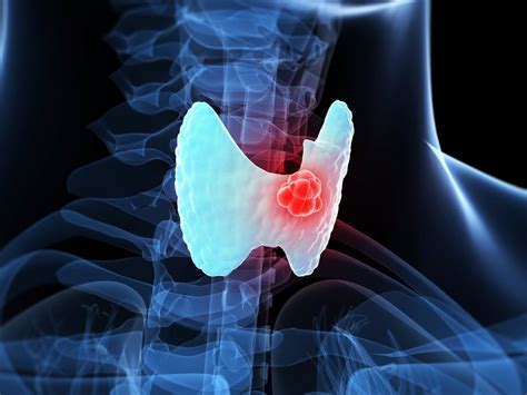 Thyroid Cancer Signs And Symptoms To Look Out For Treatment Methods
