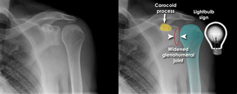 Trauma X Ray Upper Limb Gallery 1 Shoulder Dislocation Posterior