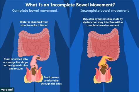 How To Reduce Symptoms Of Incomplete Defecation Bowel Movement