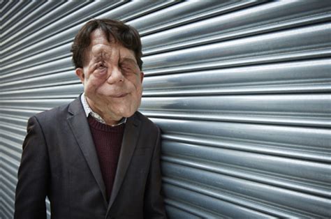 Disfigured Actor Adam Pearson Told He Should Have Be Burned Alive At