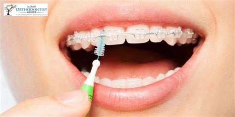 Dental Braces Types Care What To Expect Miami Orthodontist Group