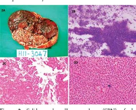 Figure 1 From Solid Pseudopapillary Neoplasm Of The Pancreas A Case