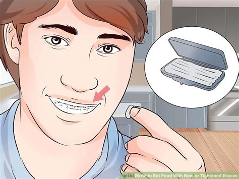 How often will my braces need to be tightened? Expert Advice on How to Eat Food With New or Tightened Braces